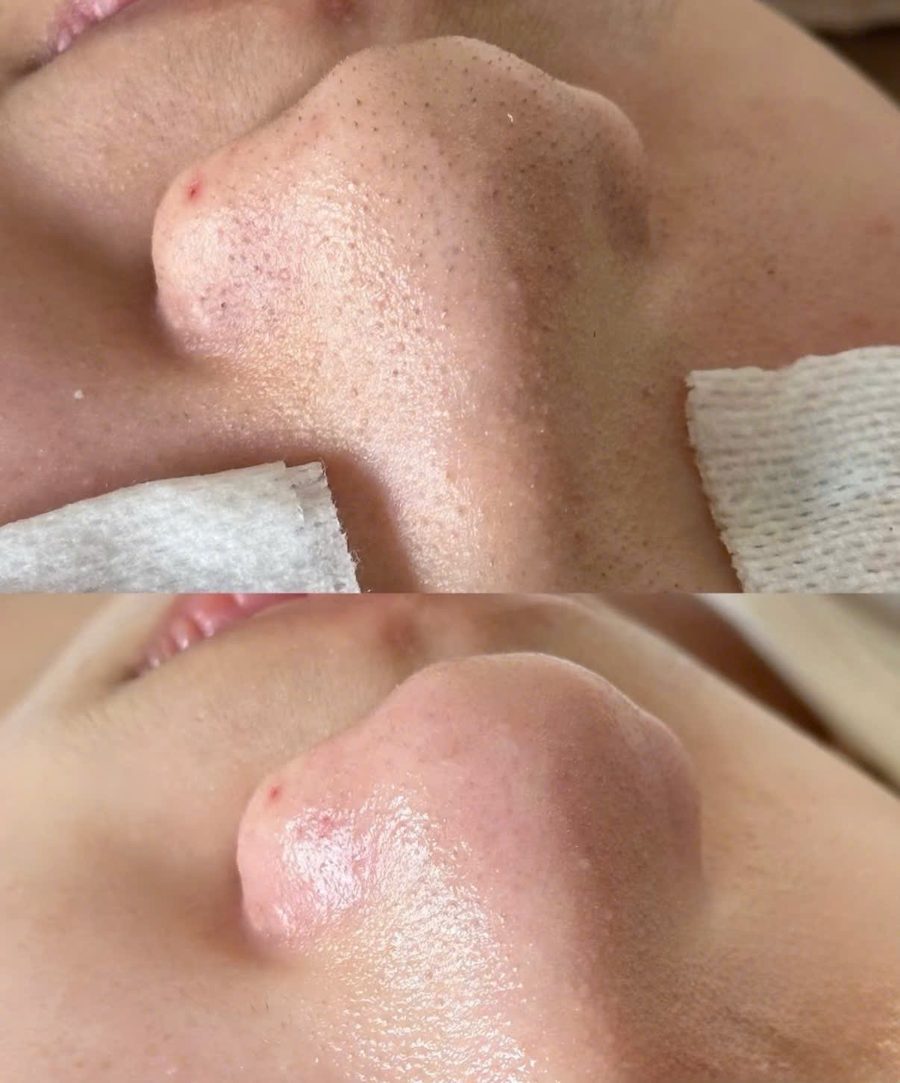 Da thông thoáng sau liệu trình